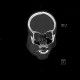 Teardrop figure, orbital floor fracture, blow-out fracture: CT - Computed tomography